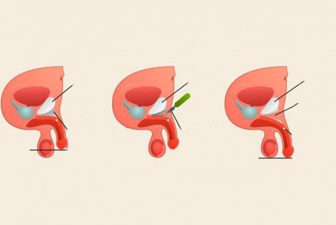 antes e depois da cirurgia de aumento do pênis